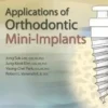 Applications Of Orthodontic Mini Implants