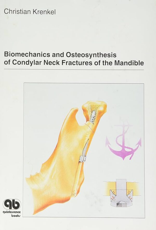 Biomechanics:Osteosynthesis Condylar