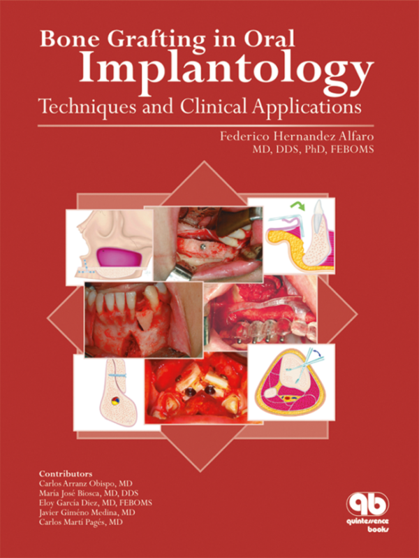 Bone Grafting In Oral Implantology